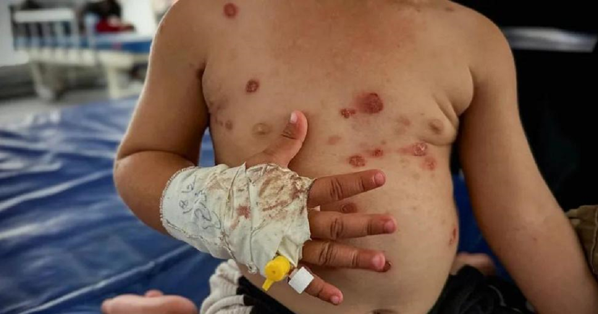 الأمم المتحدة تُحذر من تفشٍ واسع لـ "جدري الماء" بمراكز الإيواء في غزة
